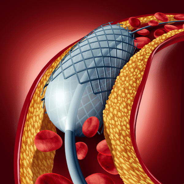 Illustration of a vascular stent implanted inside an artery, supporting blood vessel patency and cardiovascular device performance testing.
