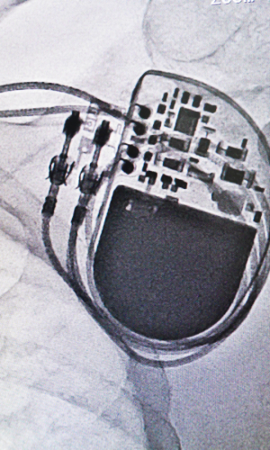 X-ray image showing an implanted cardiac pacemaker with connected leads inside the chest.